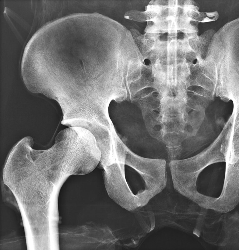 Full Body röntgen fantoom
