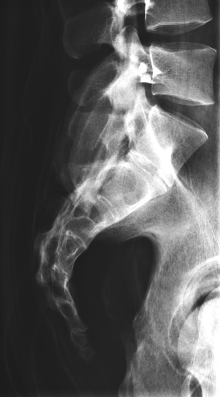 Full Body röntgen fantoom